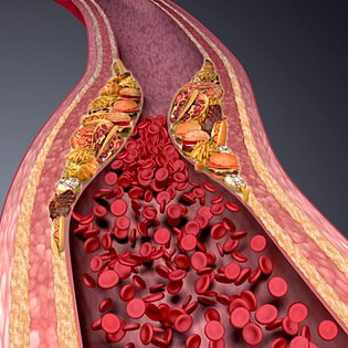 Arteriosklerose ist eine Systemerkrankung in den Schlagadern