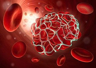 Blutverdünner sind dringend erforderlich bei einem drohenden Blutgerinsel