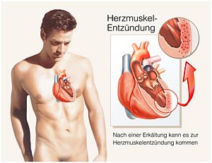 Myokarditis - Herzmuskelentzündung